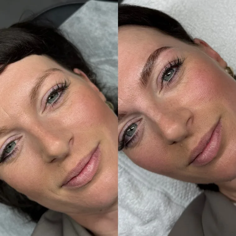Brow Lift – weiteres Ergebnis · PMU Rotenburg (Wümme)